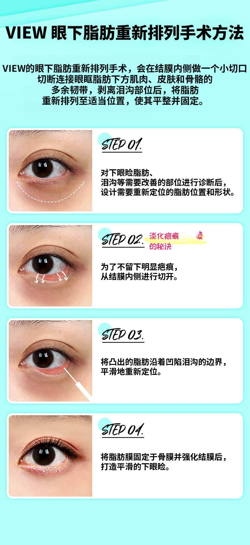 ❤️维❤️眶隔脂肪释放