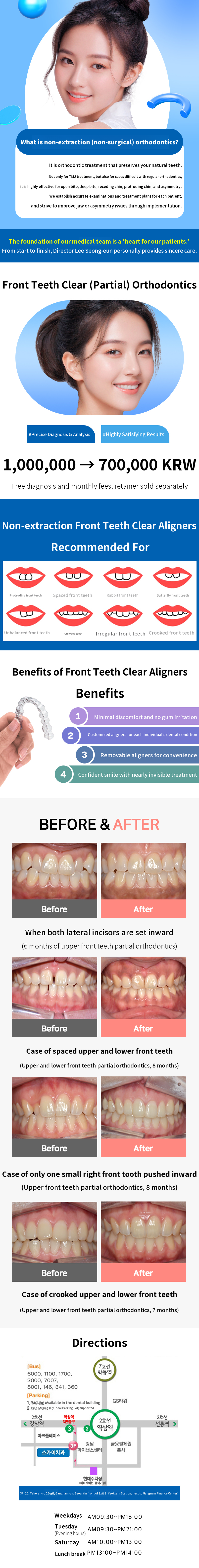 [Special Price] Transparent (Partial) Correction for Front Teeth