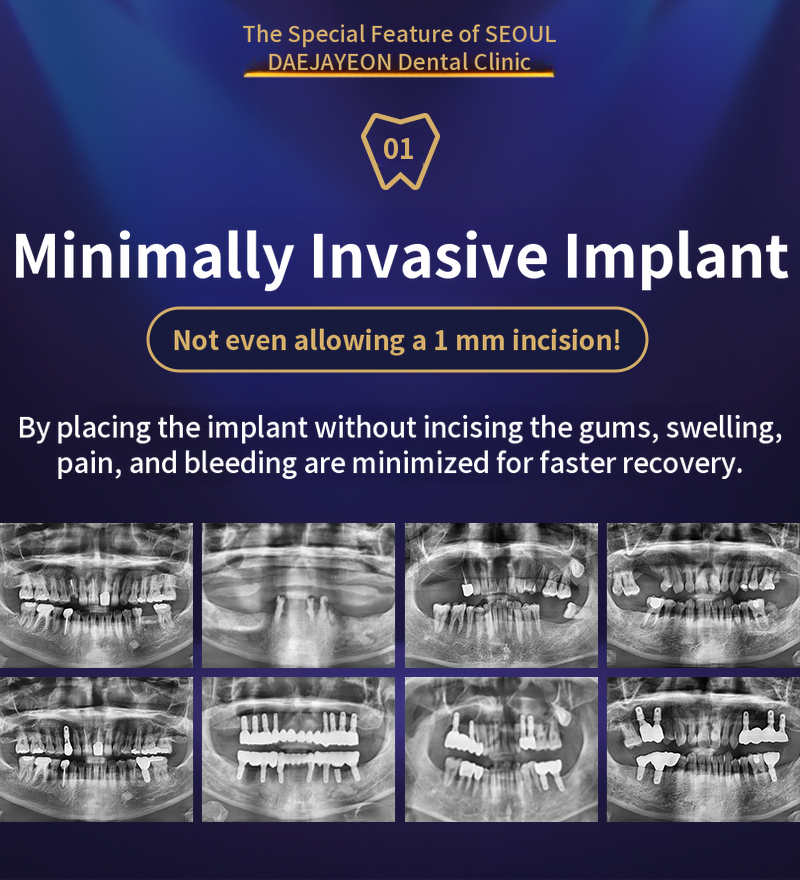 Minimally invasive, quick recovery at Seoul The Nature Implant