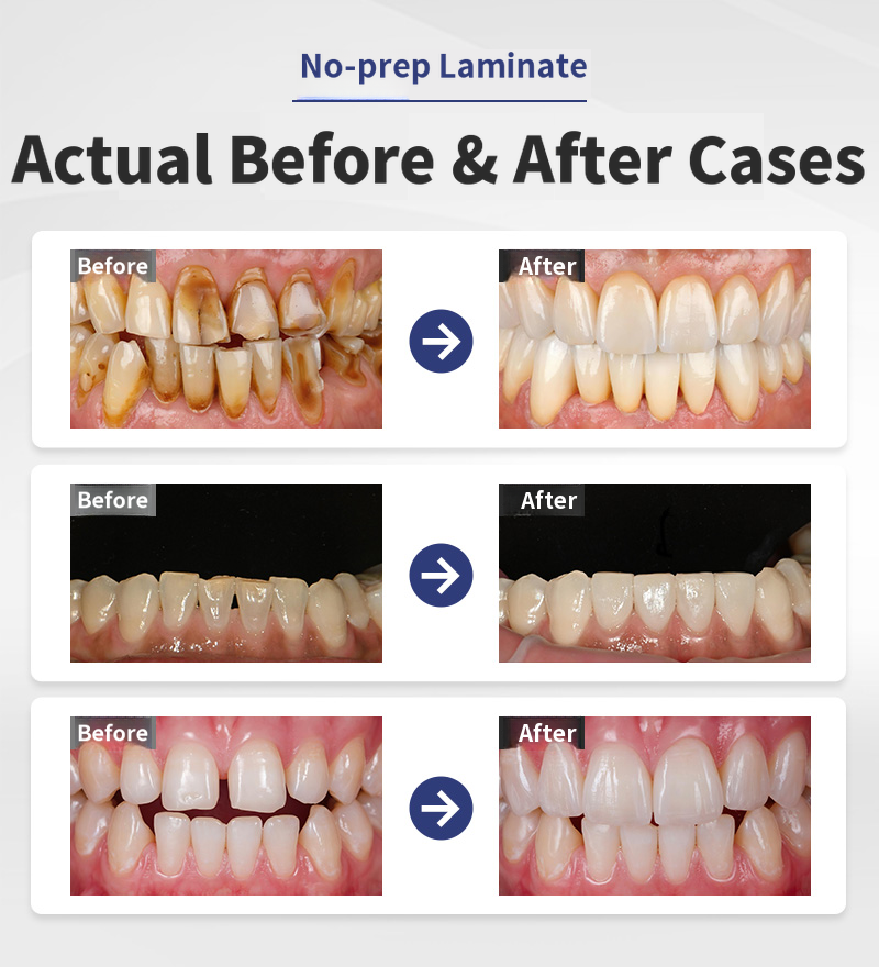 Natural Beauty, No-Removal Laminate