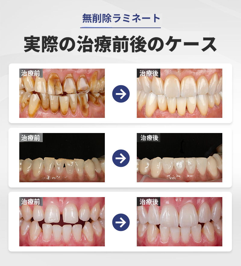 自然な美しさ、無削除ラミネート