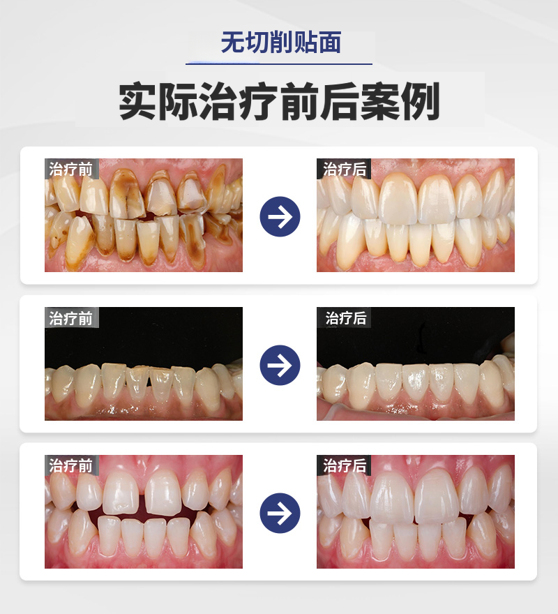 自然之美，无删除贴面