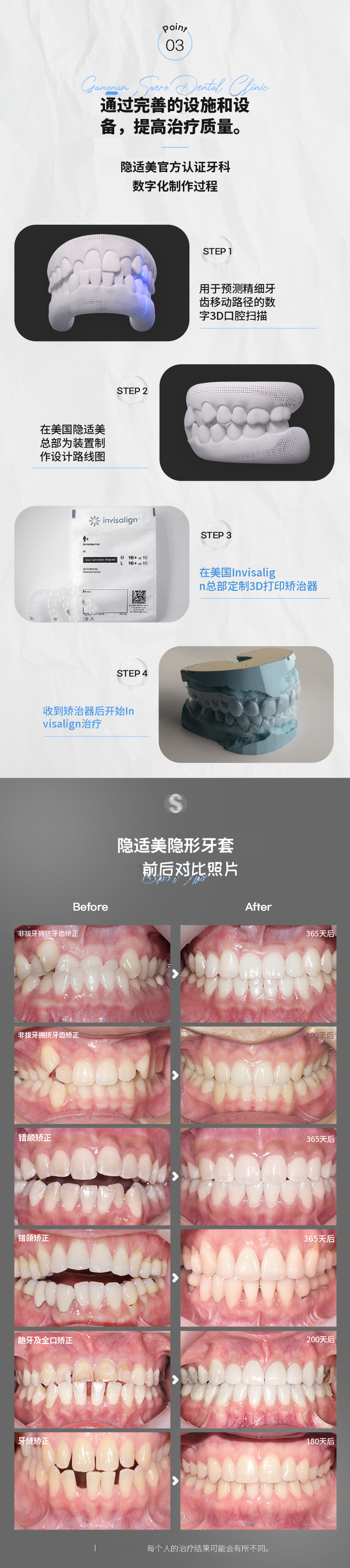 聪明的选择隐形牙套快速版