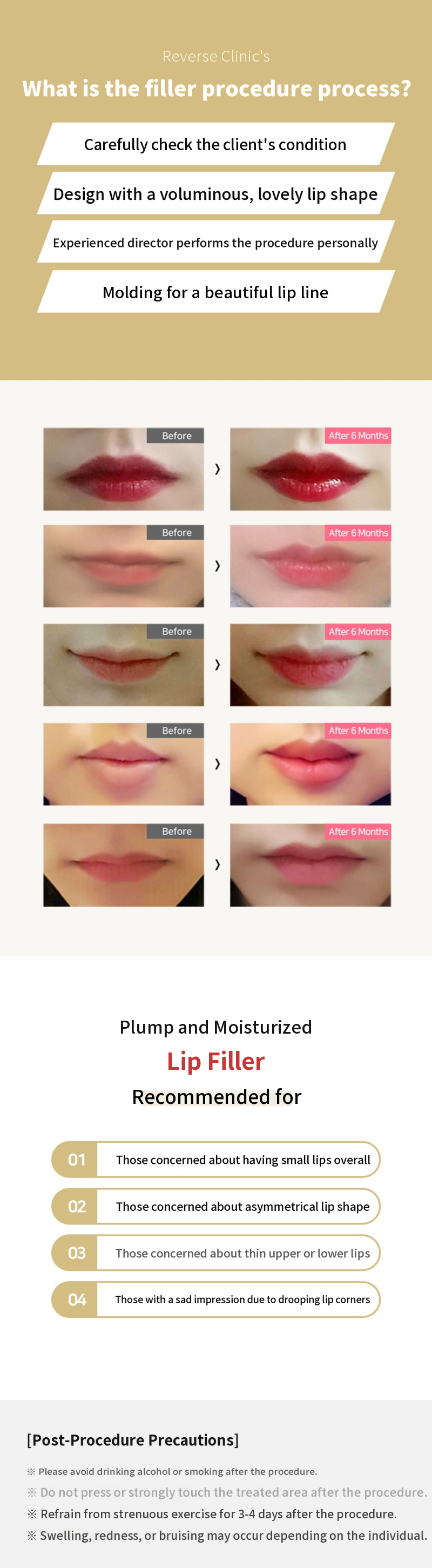 Lip Filler for Fuller Lips