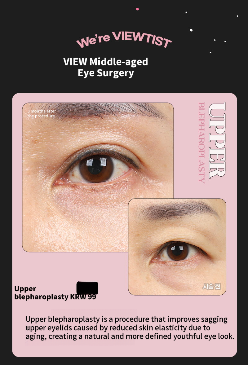 ❤️View❤️Middle-aged Eye Surgery