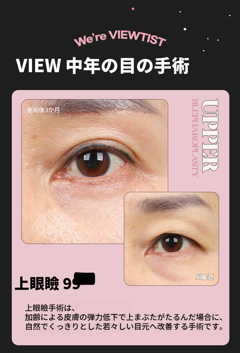 ❤️ビュ❤️中年の目の整形