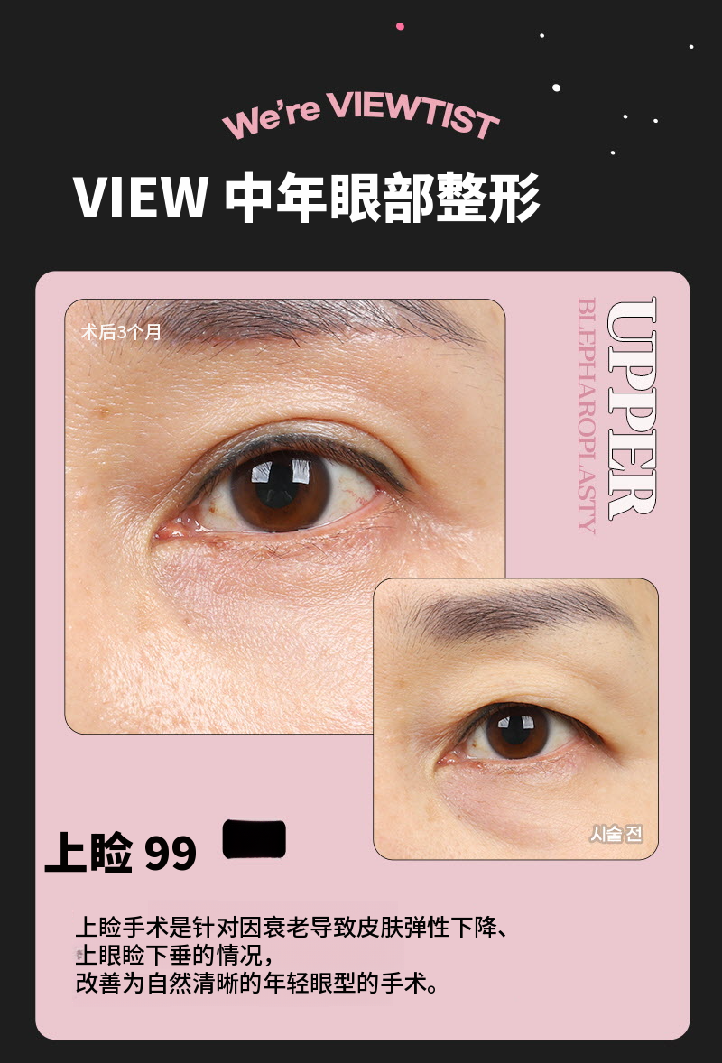 ❤️视❤️中年眼部整形