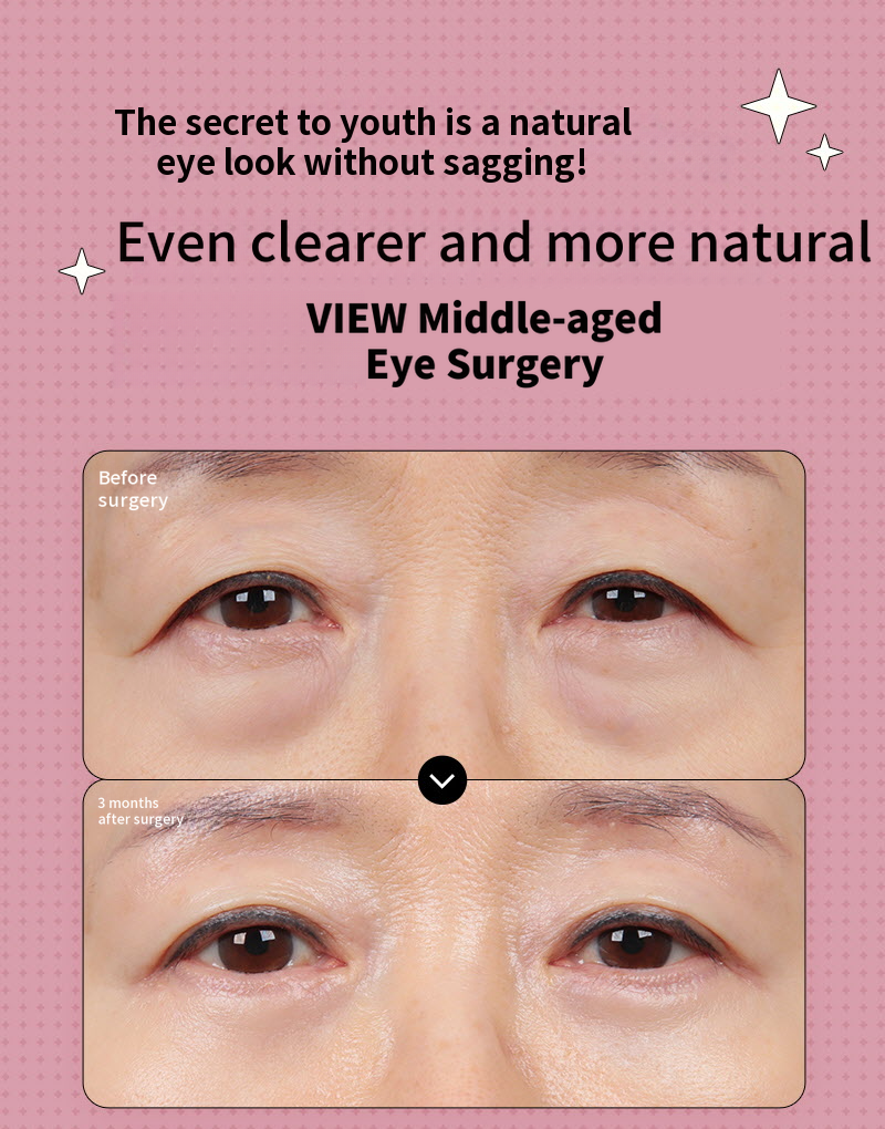 ❤️View❤️Middle-aged Eye Surgery