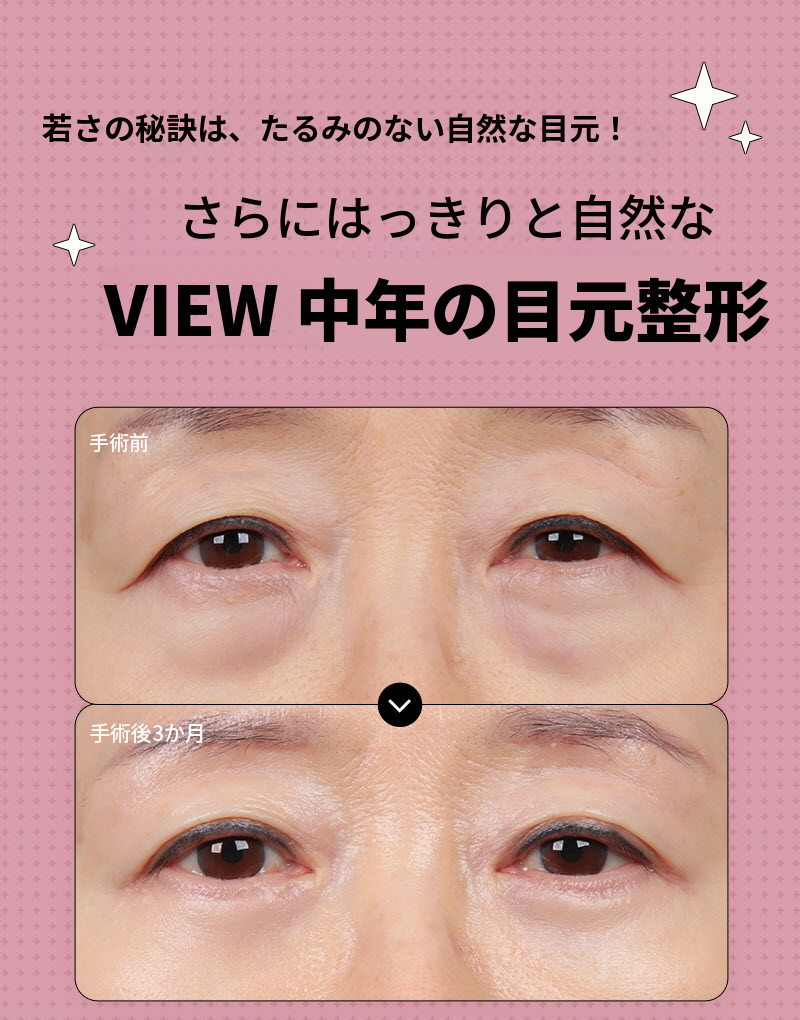 ❤️ビュ❤️中年の目の整形