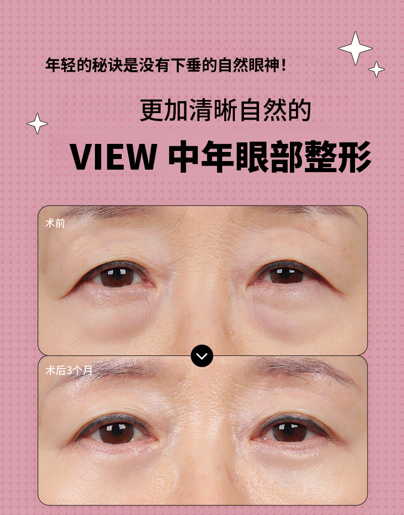 ❤️视❤️中年眼部整形