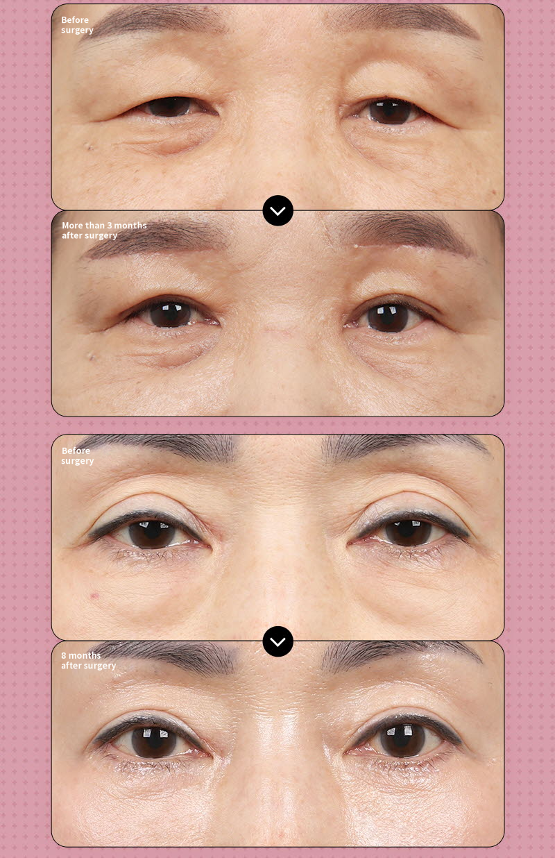 ❤️View❤️Middle-aged Eye Surgery