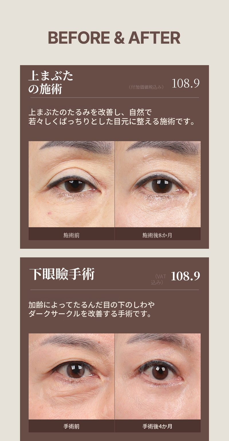 ❤️ビュー❤️中高年の目元整形