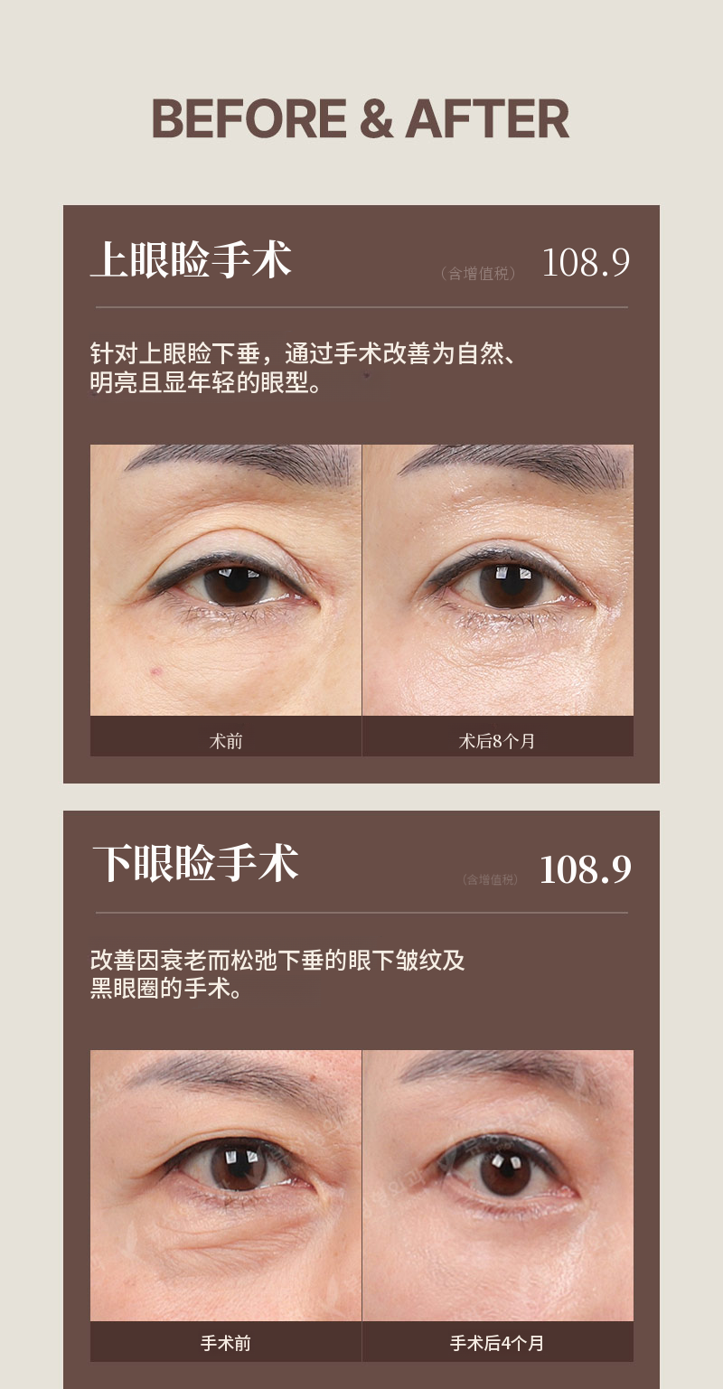 ❤️美❤️中年眼部整形