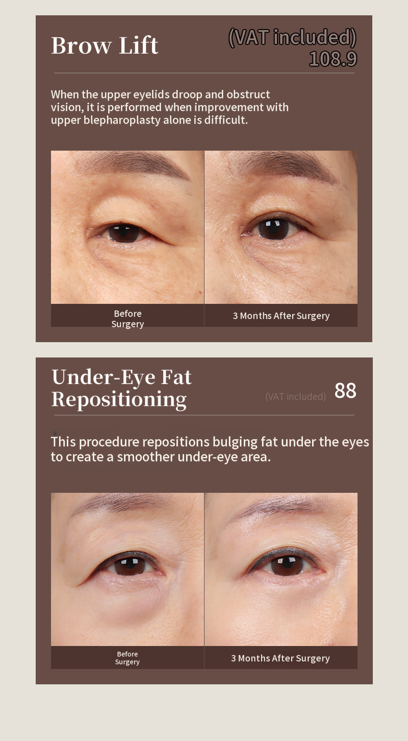 ❤️View❤️ Eye Surgery for Middle-Aged Patients