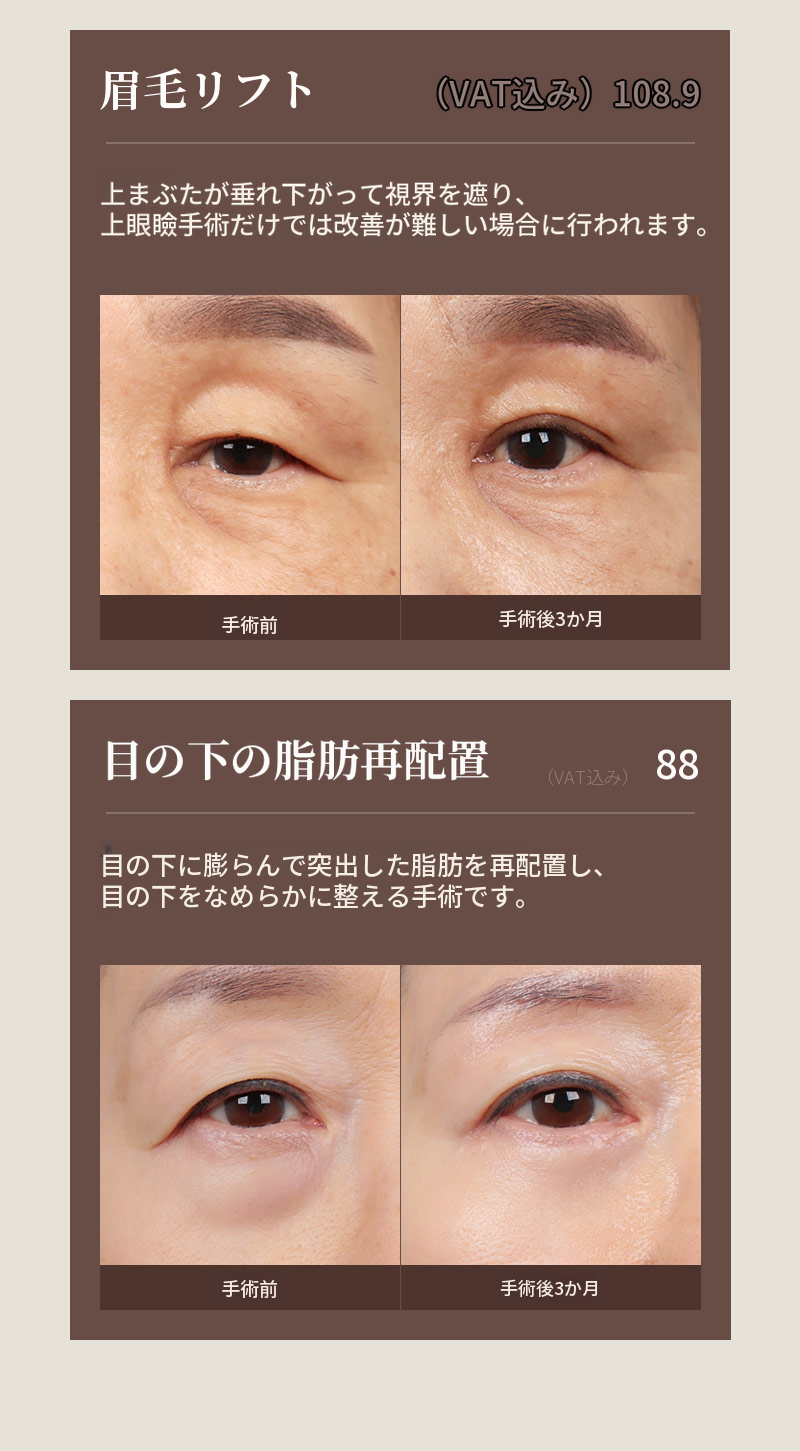 ❤️ビュー❤️中高年の目元整形