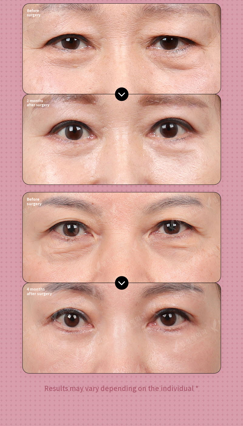 ❤️View❤️Middle-aged Eye Surgery