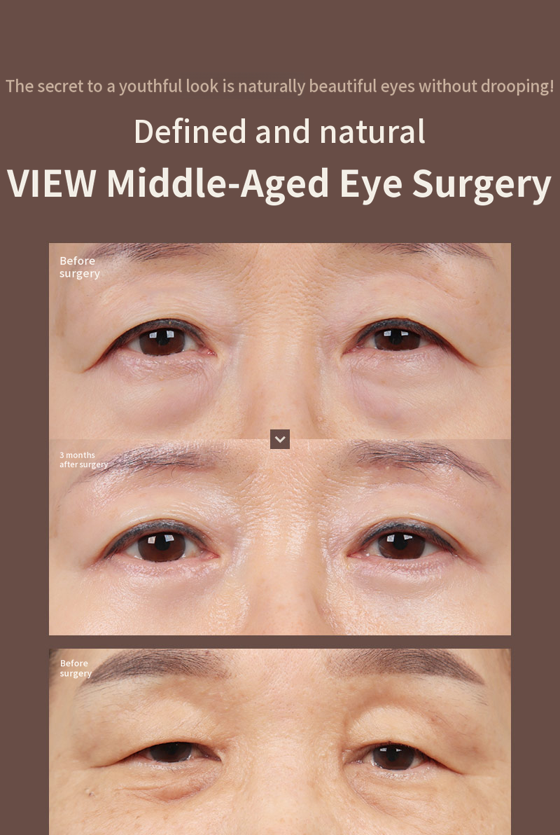 ❤️View❤️ Eye Surgery for Middle-Aged Patients