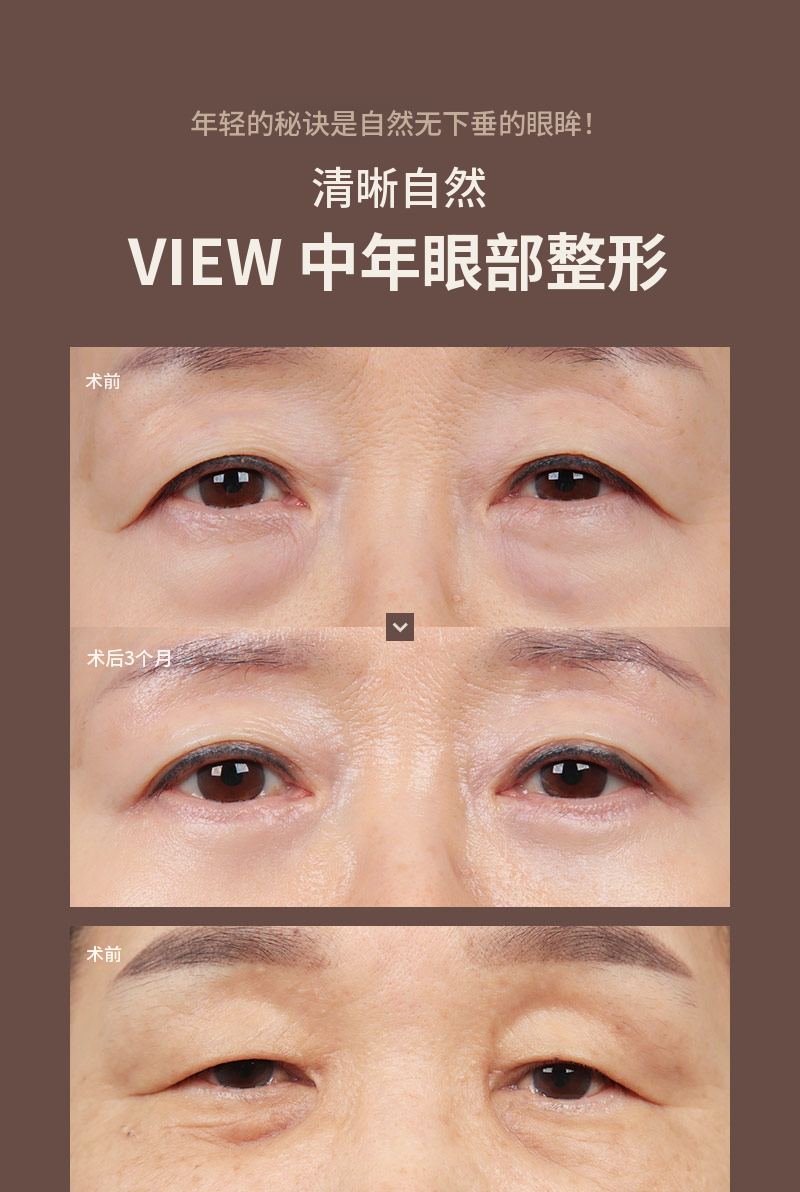 ❤️美❤️中年眼部整形