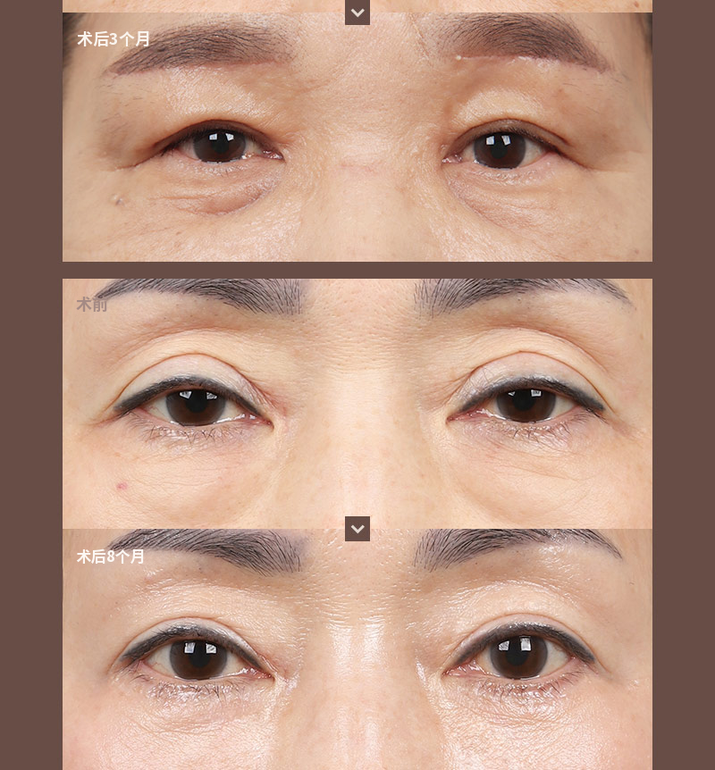 ❤️美❤️中年眼部整形