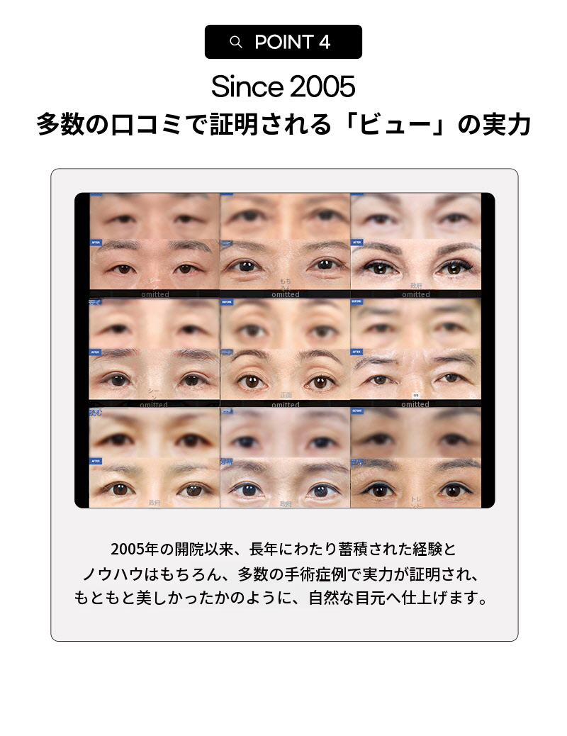 ❤️ビュ❤️中年の目の整形