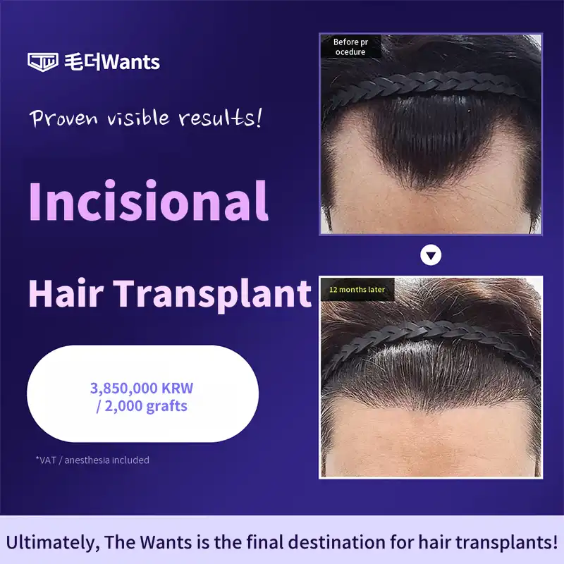 Natural Incisional Hair Transplant 2000 Grafts