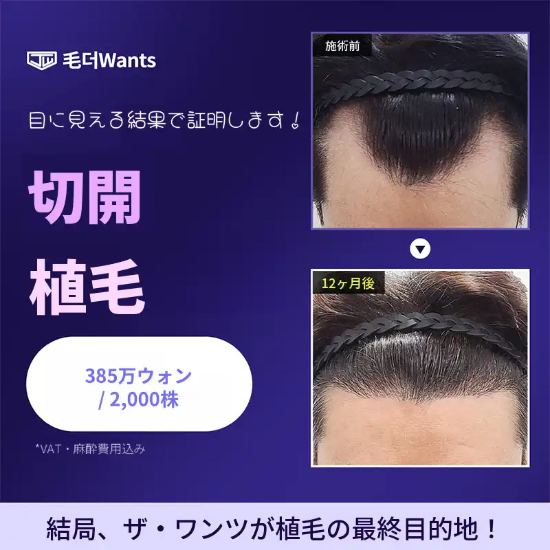 自然な切開毛髪移植 2000本