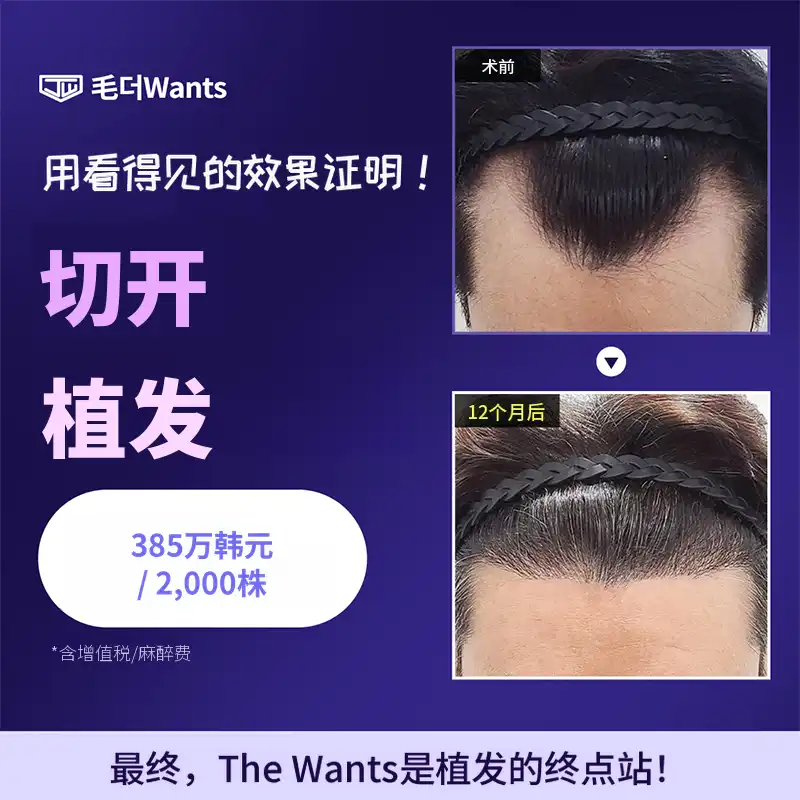 自然切口毛发移植2000毛