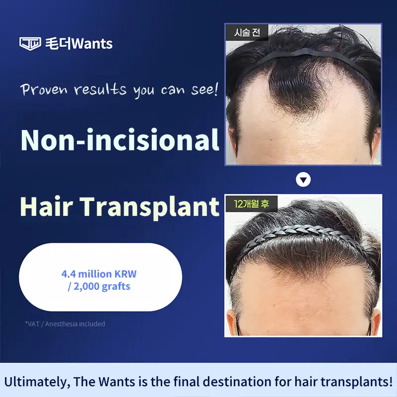 Minimizing Scars, Non-Incisional Hair Transplant