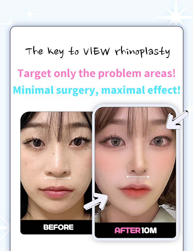 ❤️View❤️Nasal Wing Reduction