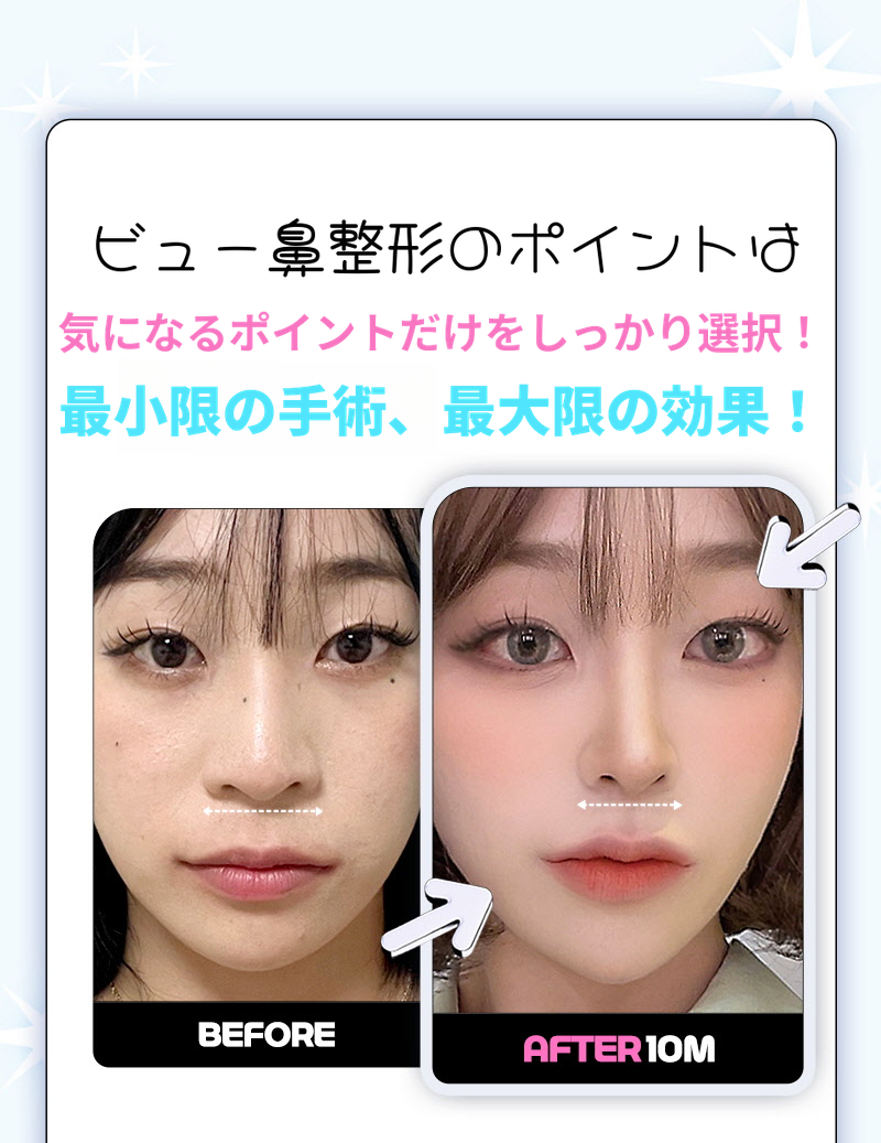 ❤️ビュー❤️鼻翼縮小