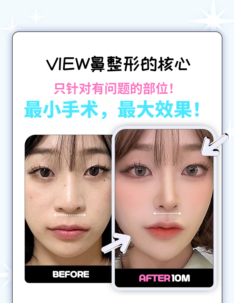 ❤️美丽❤️鼻翼缩小