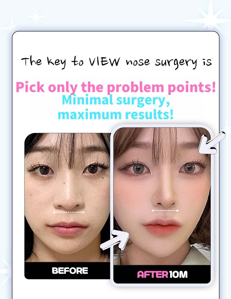 ❤️View❤️Nasal Wing Reduction