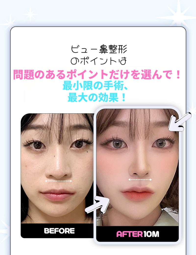 ❤️ビュー❤️鼻翼縮小
