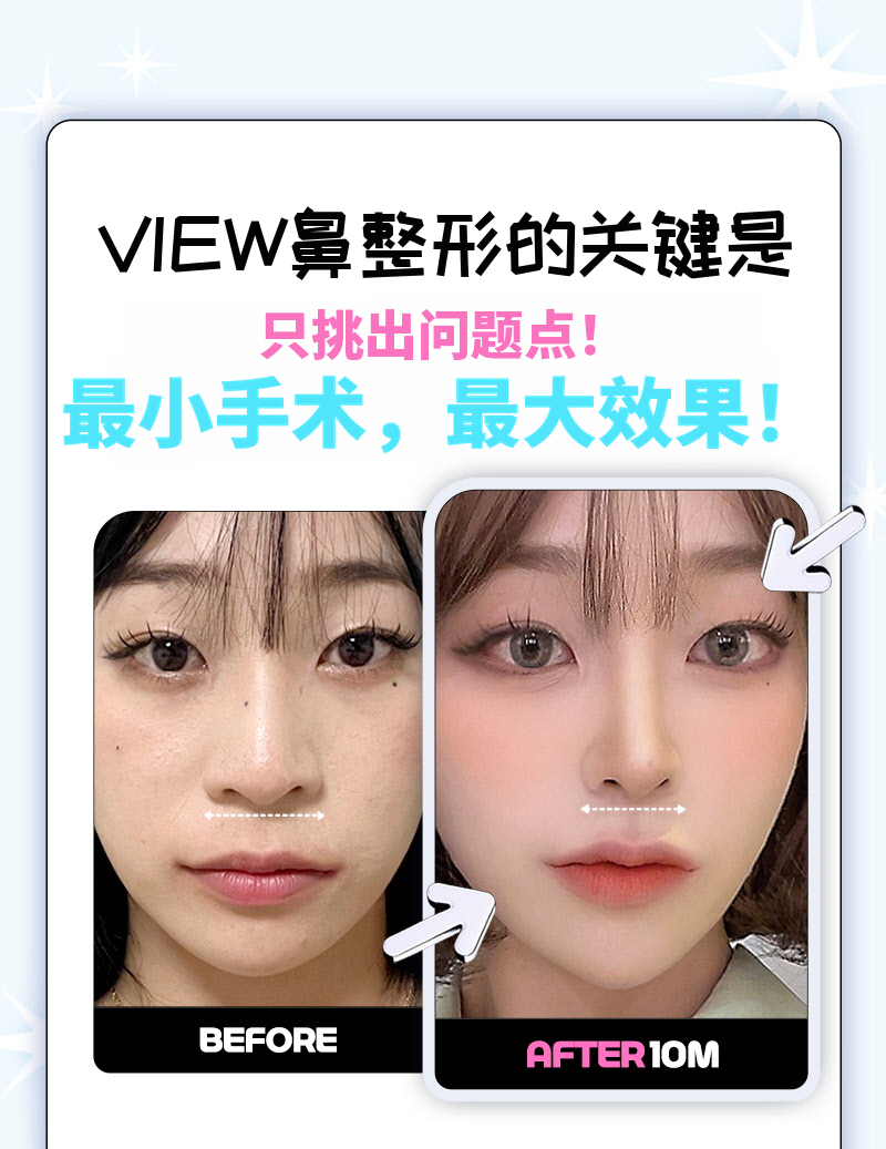 ❤️视图❤️鼻翼缩小