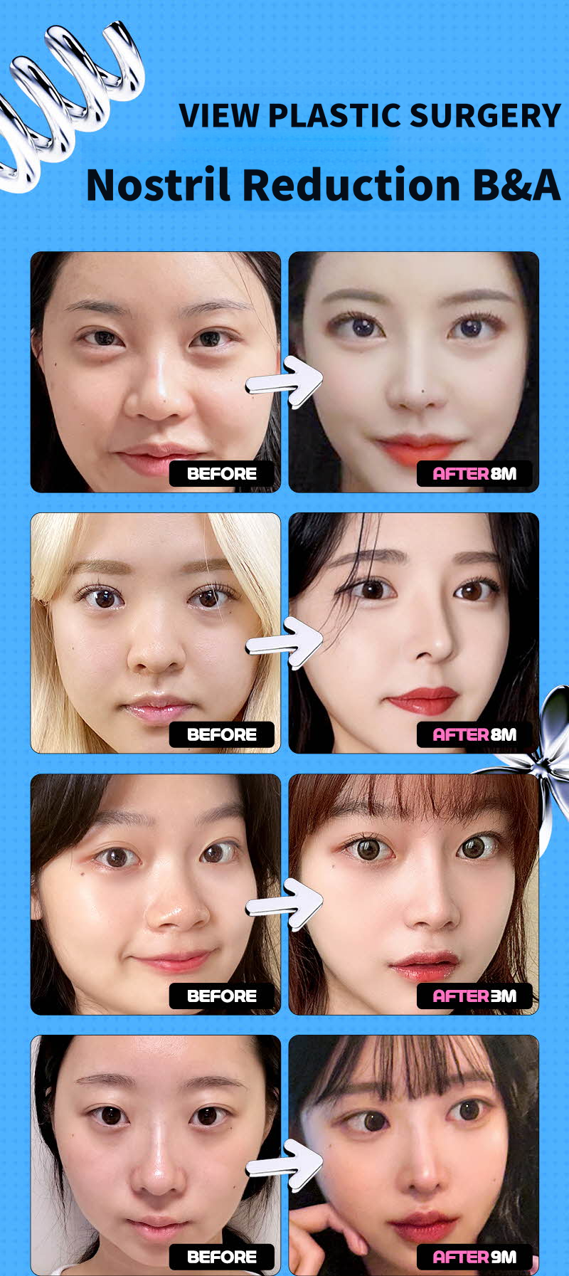 ❤️View❤️Nasal Wing Reduction