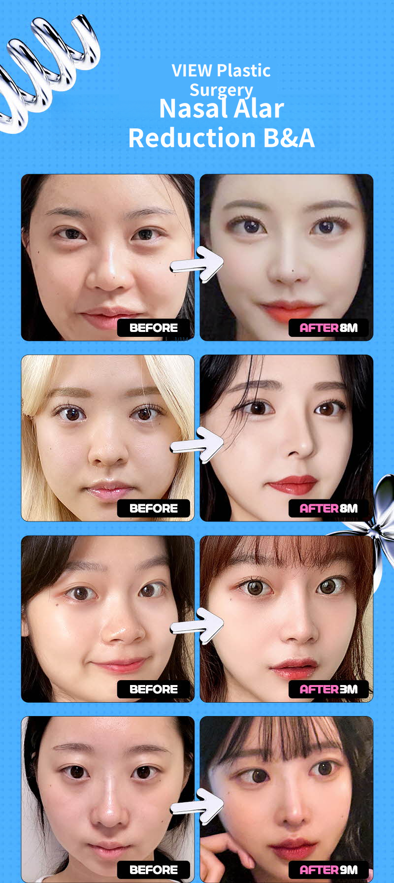 ❤️View❤️Nasal Wing Reduction