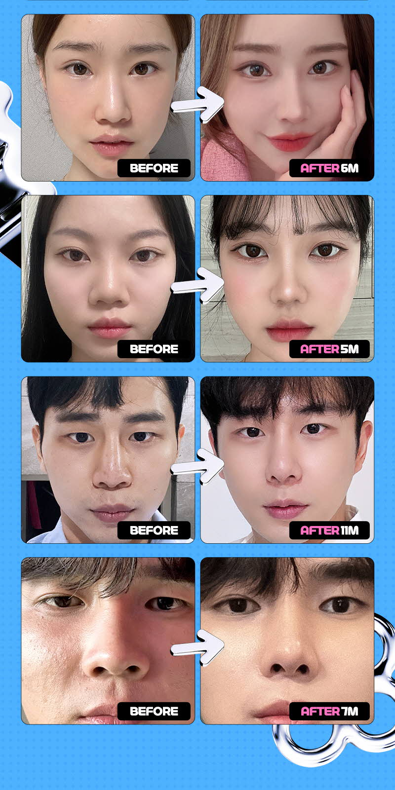 ❤️View❤️Nasal Wing Reduction