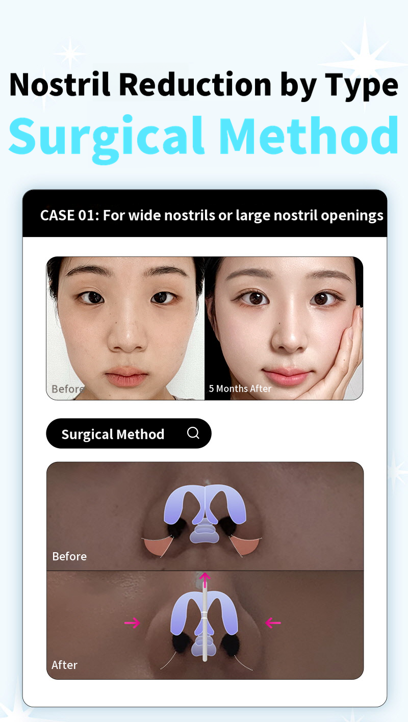 ❤️View❤️Nasal Wing Reduction