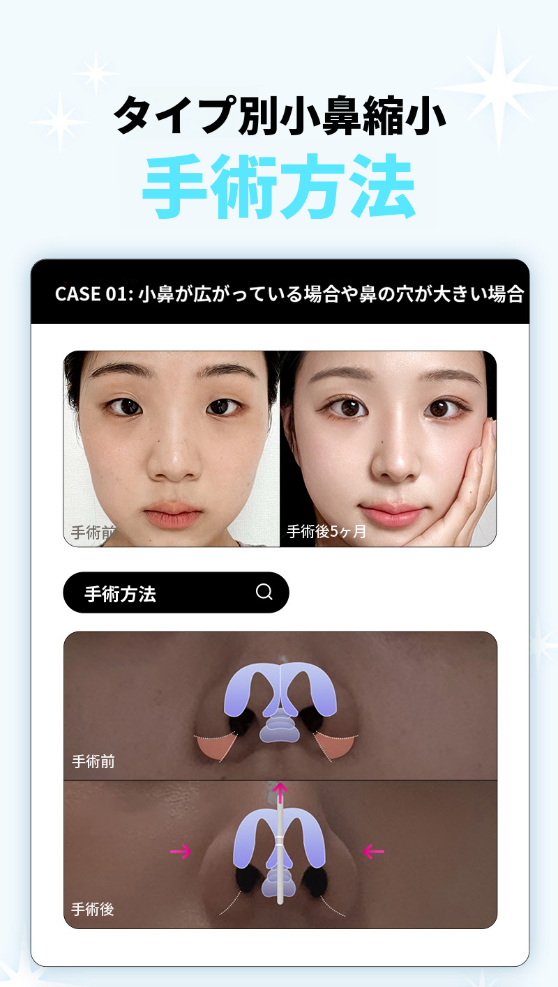 ❤️ビュー❤️鼻翼縮小