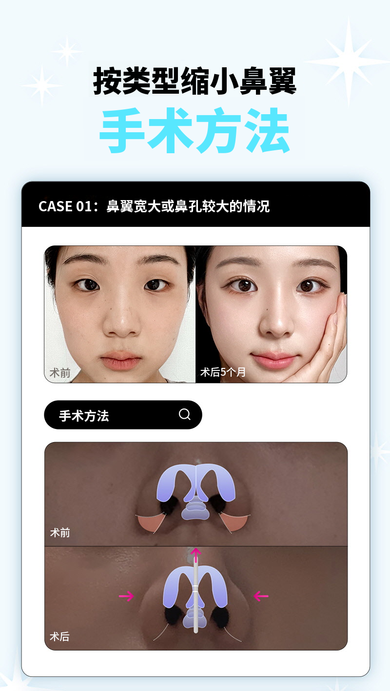 ❤️美丽❤️鼻翼缩小