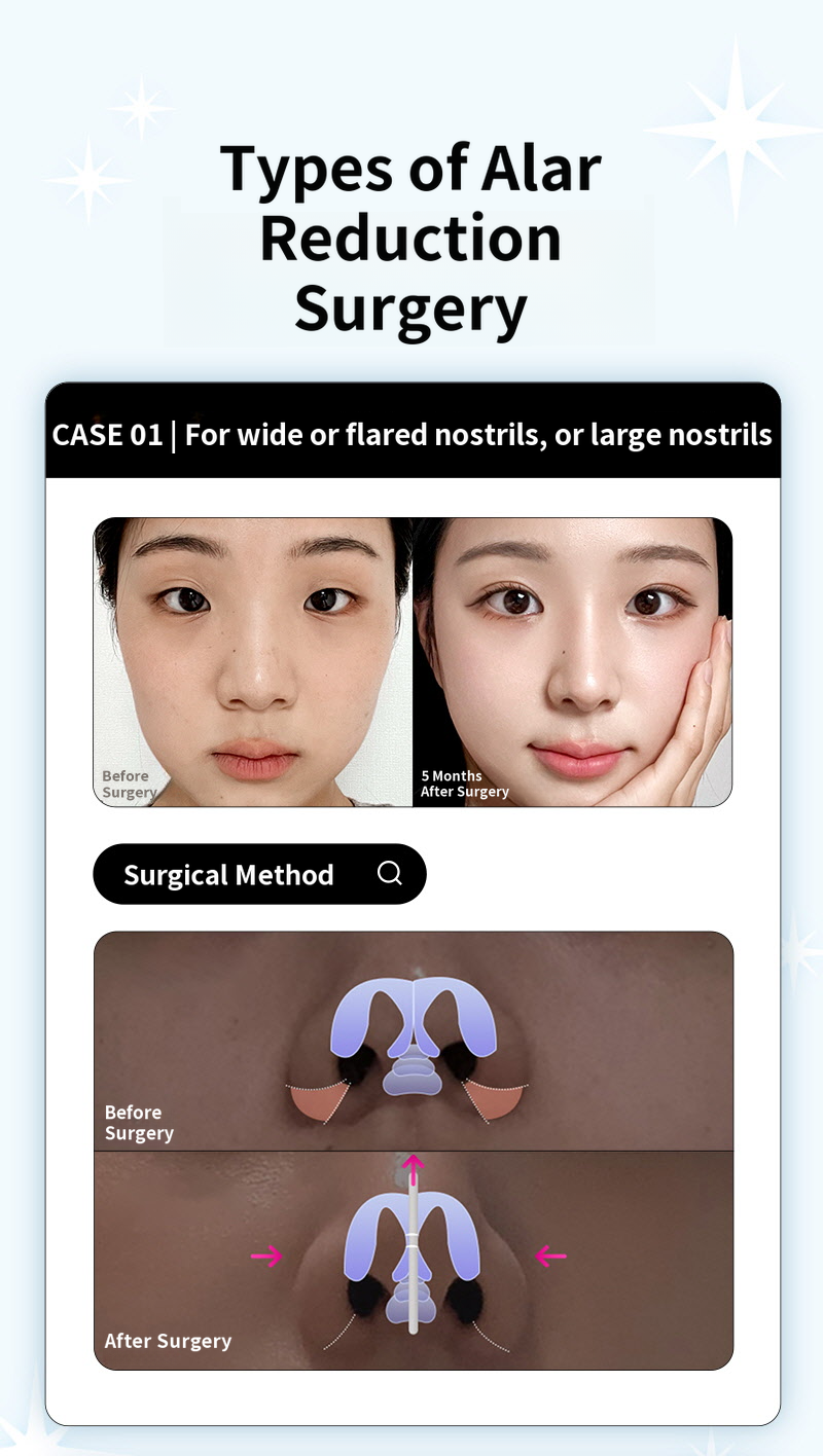 ❤️View❤️Nasal Wing Reduction