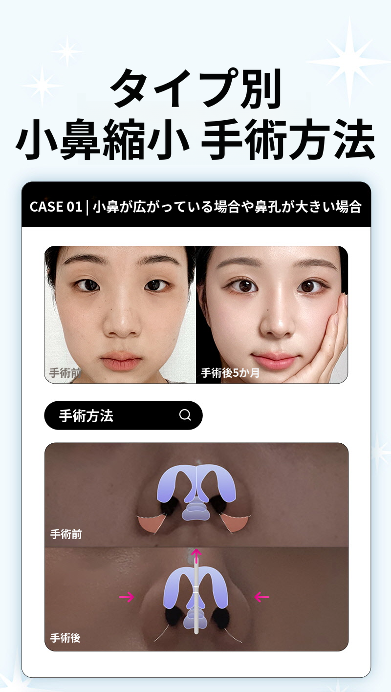 ❤️ビュー❤️鼻翼縮小