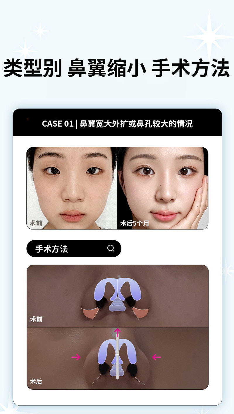 ❤️视图❤️鼻翼缩小