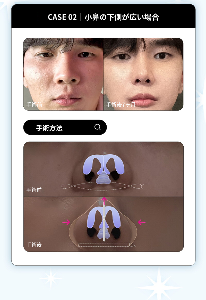 ❤️ビュー❤️鼻翼縮小