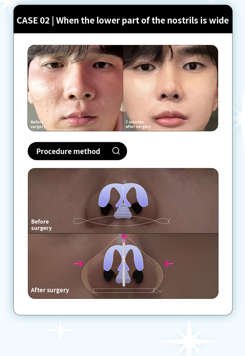 ❤️View❤️Nasal Wing Reduction