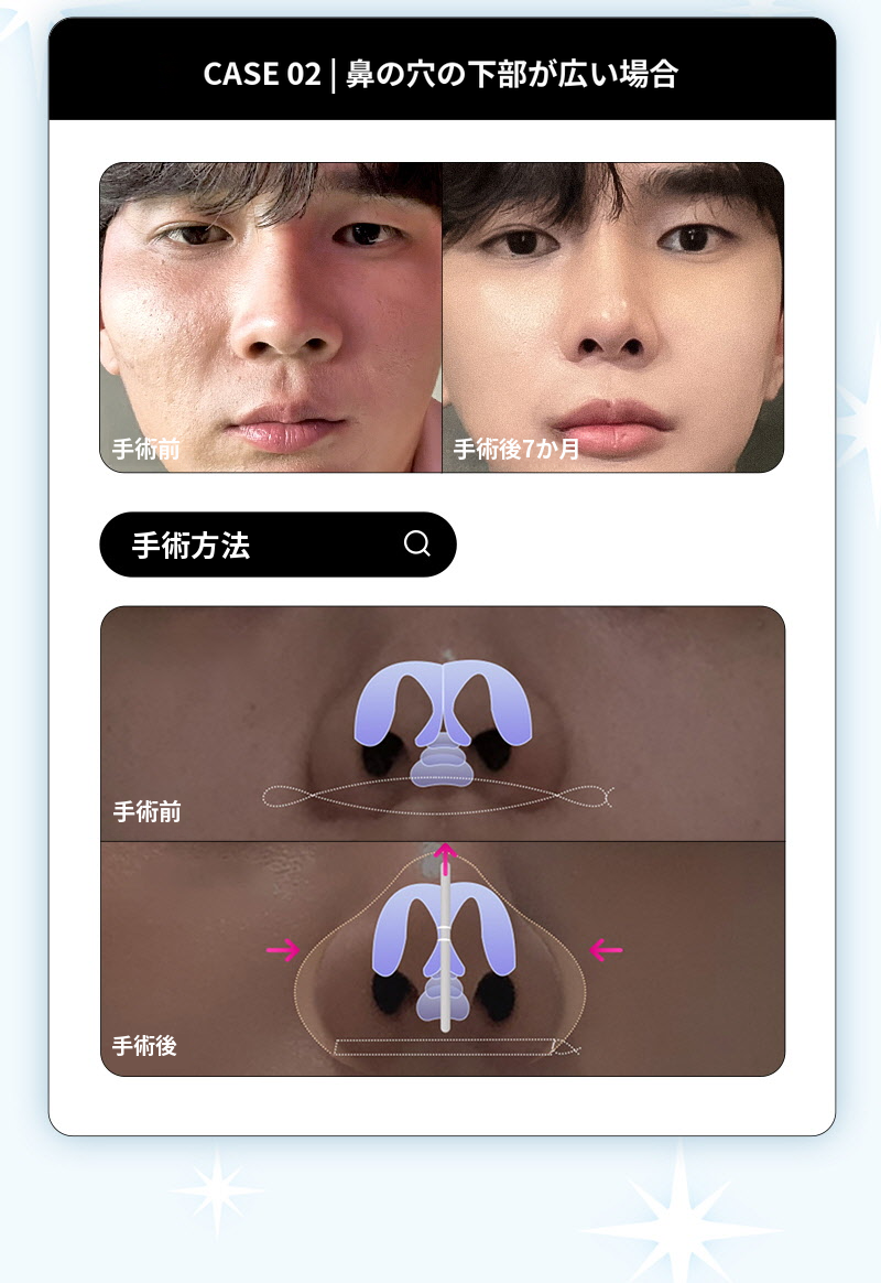 ❤️ビュー❤️鼻翼縮小