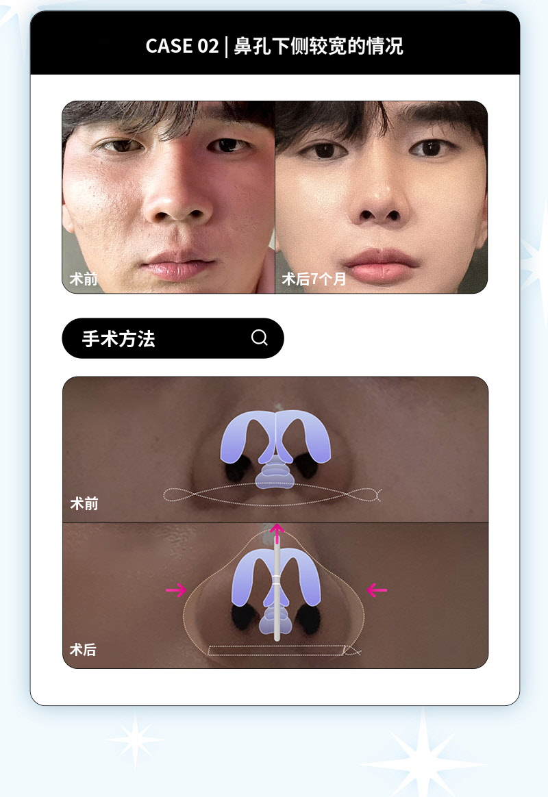 ❤️视图❤️鼻翼缩小