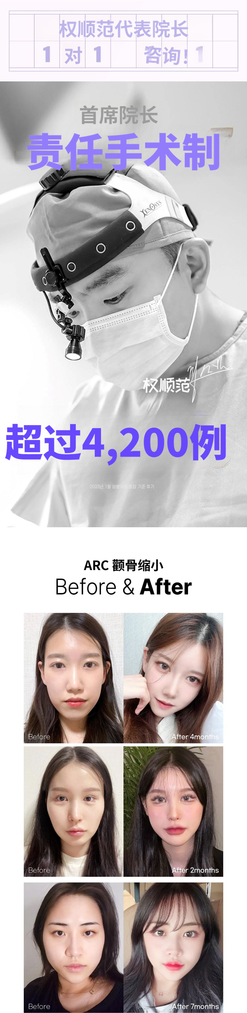 Aqua_颧骨缩小