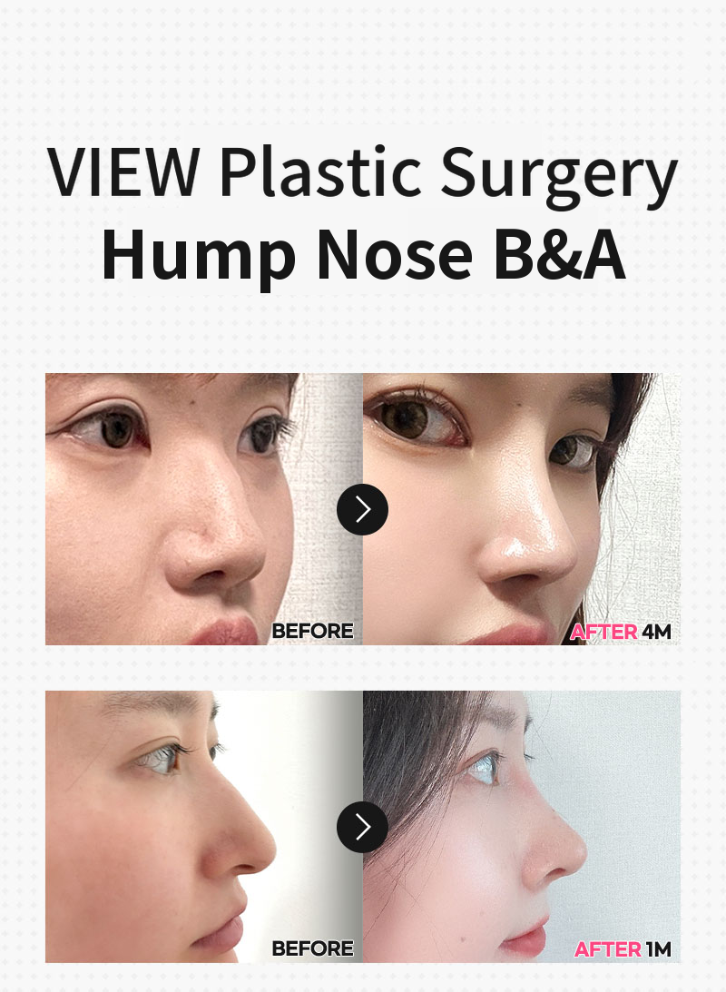 ❤️View❤️Nasal Surgery