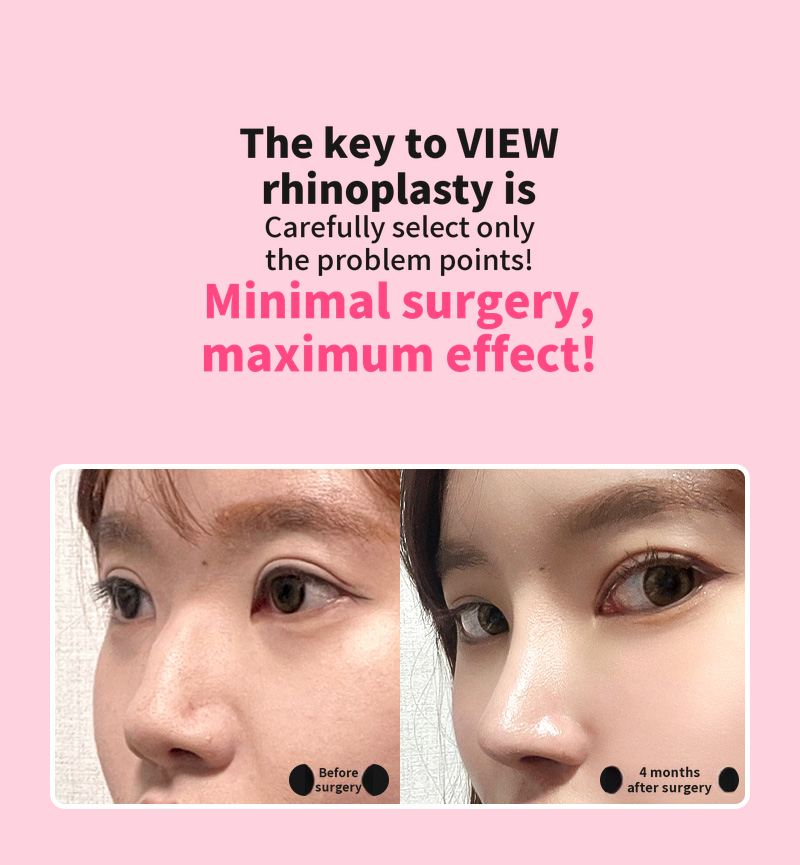 ❤️View❤️Nasal Surgery